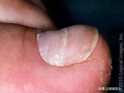 指甲有白点肚子里有蛔虫？月牙越大越健康？指甲软是缺钙……