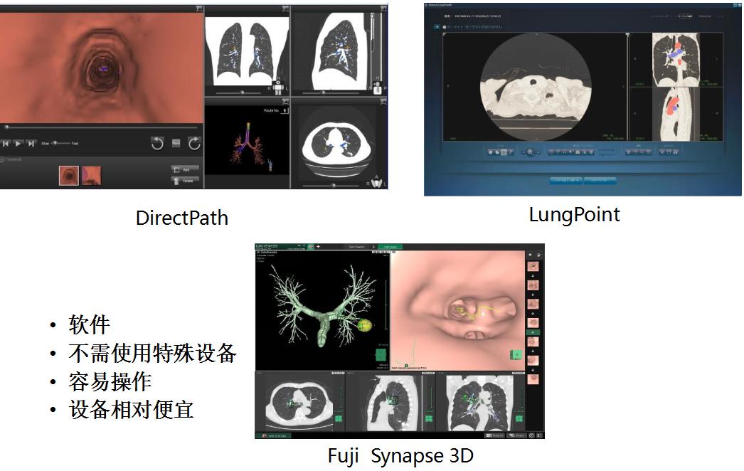 小细胞肺癌的气管镜介入治疗,导航支气管镜在肺癌诊断中的应用