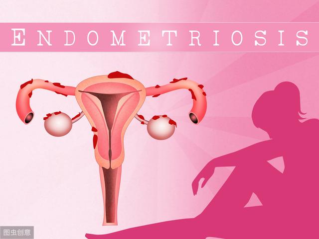 卵巢巧克力囊肿并且有点肠子粘连,卵巢巧克力囊肿穿刺会影响卵巢吗