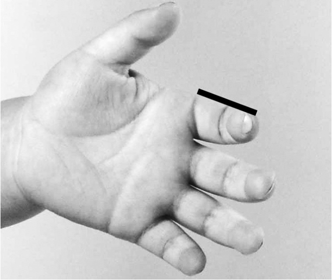 儿童扁桃体肥大最简单的偏方,小儿扁桃体肥大反复发炎怎么办