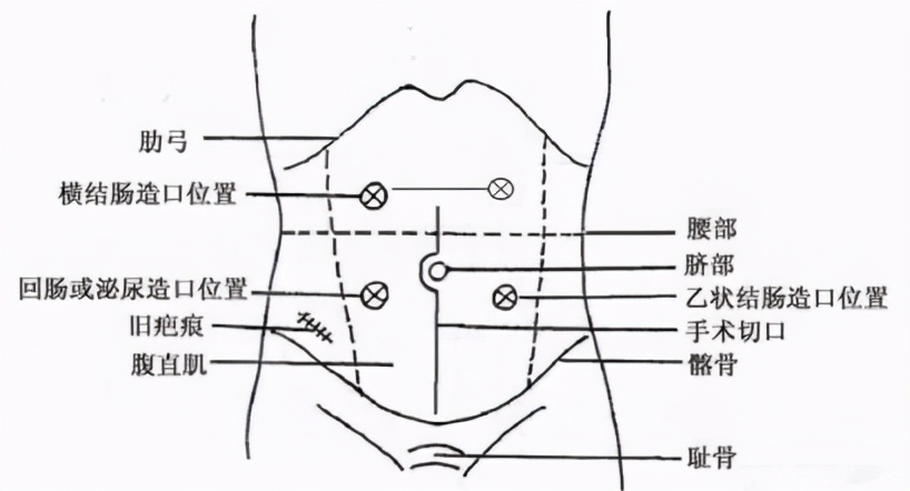 肠造口作用、位置、分类，一文秒懂