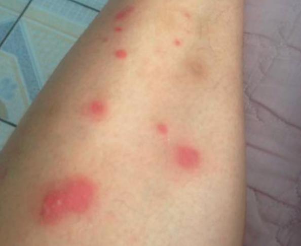 身上若是出现湿疹,多半与这4个原因有关,早知道早好