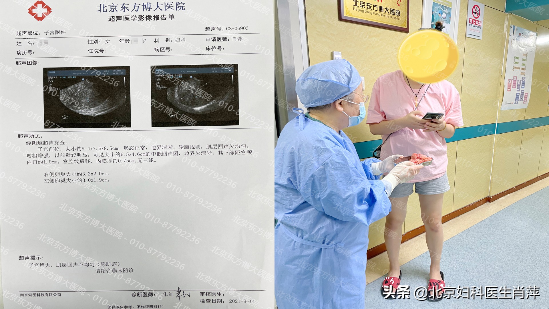 子宫腺肌症保宫术效果好吗,子宫腺肌症保宫术