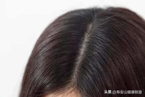 被顽固头屑缠上的四大理由，最后一个你绝对想不到