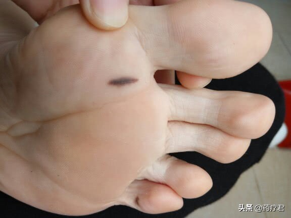 男子发现脚底有异样,男子发现全身无力查出来是肠癌