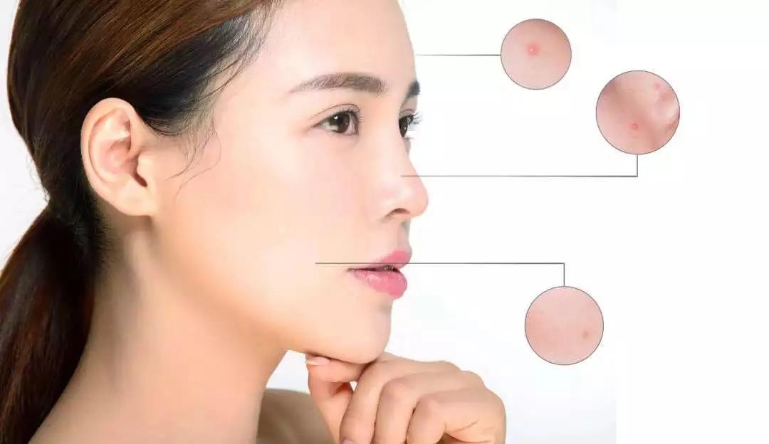 鼻子上闭合性粉刺,面部闭合性粉刺怎么消除