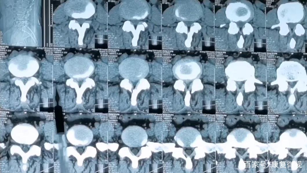 椎间盘突出腰腿疼消失,椎间盘突出腰腿痛能根治吗