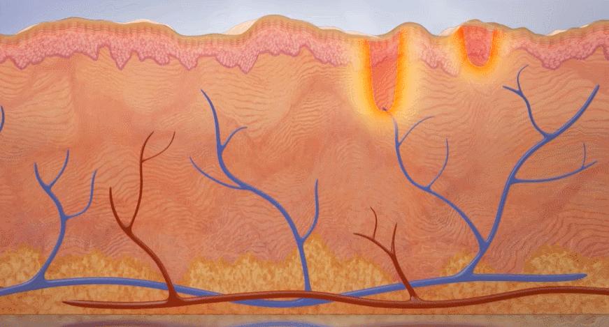 毛孔粗大问题应该如何正确解决,毛孔粗大怎么办教你一招根除