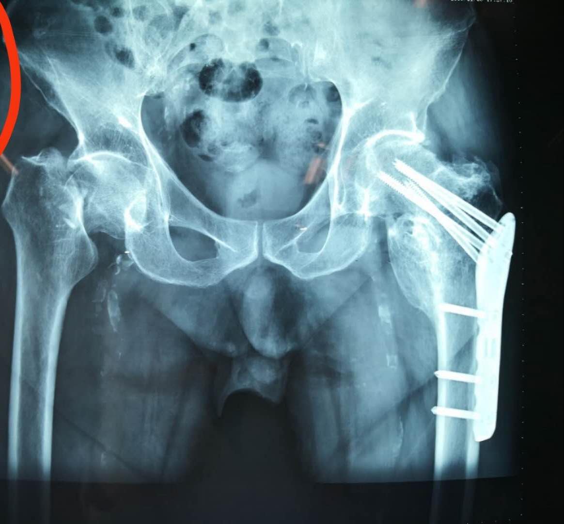 脑血栓遭罪的视频,家有病人要注意什么