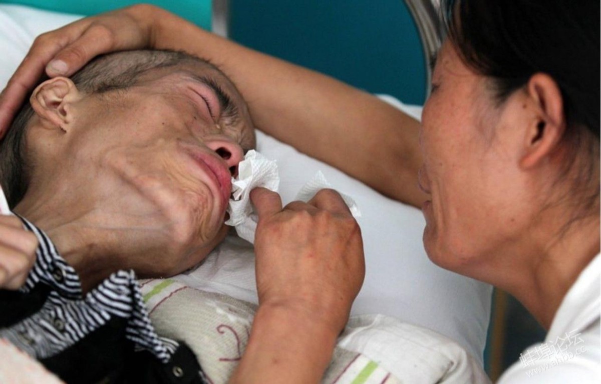 癌症病人是被治死的吗,癌症病人是吓死的还是治疗死亡的