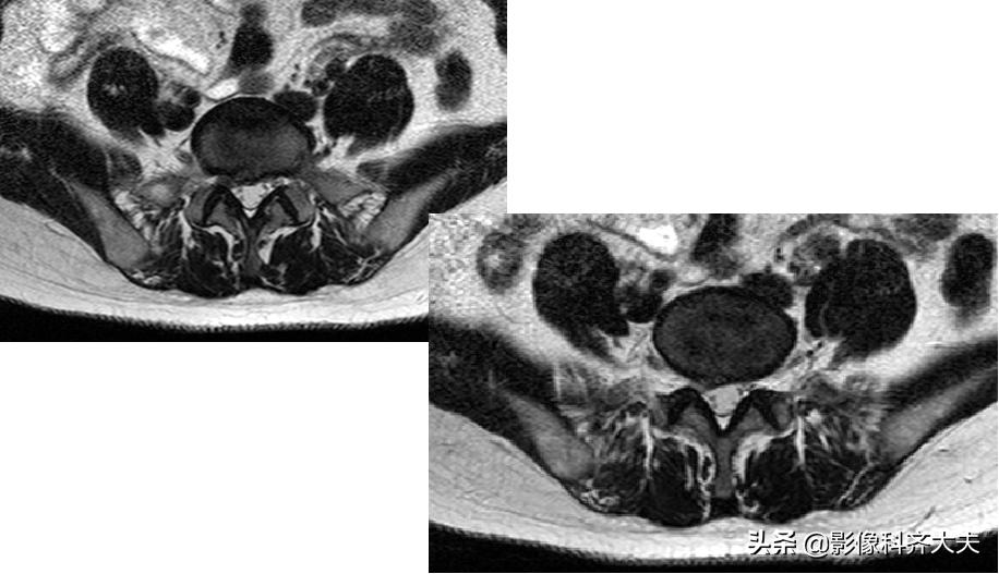 腰椎间盘突出最好的影像诊断方法,腰椎间盘突出的影像学检查