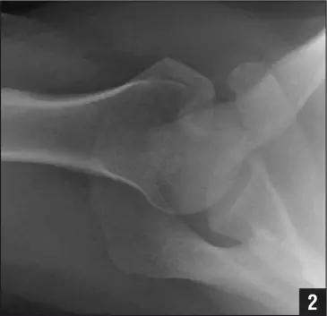 特殊骨折类型,特殊骨折体征