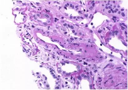 肾毒性的药物排名,肾毒性食物有哪些