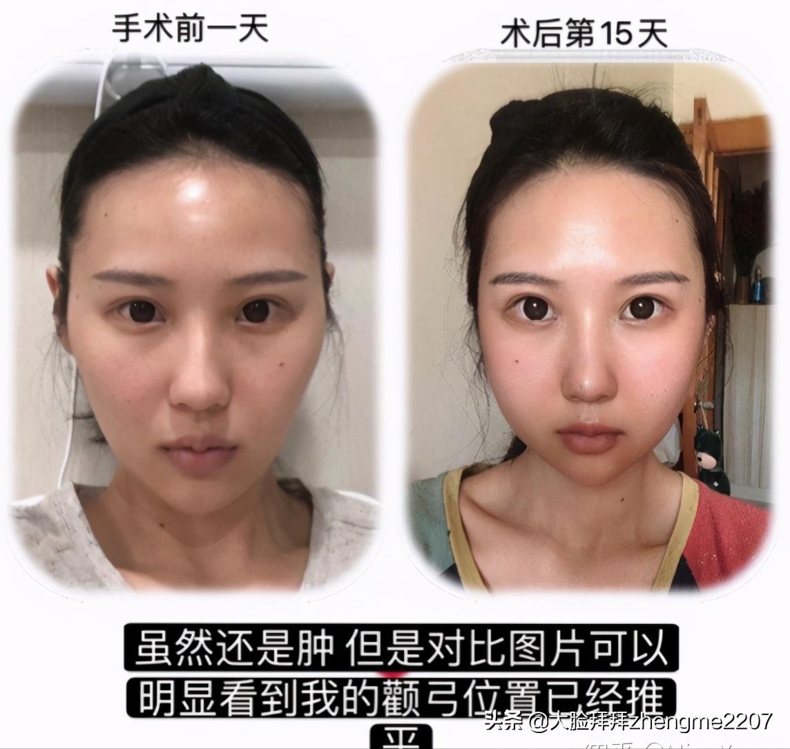 颧骨颧弓内推手术全过程真人,颧骨内推颧弓手术恢复全过程分享