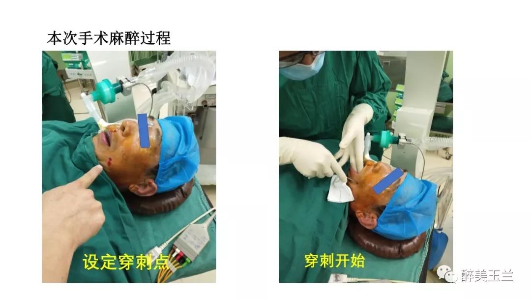 病例分享丨三叉神经节微球囊压迫术的麻醉管理