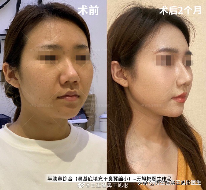 大鼻头缩小的改善原理,鼻头毛孔粗大如何改善缩小毛孔