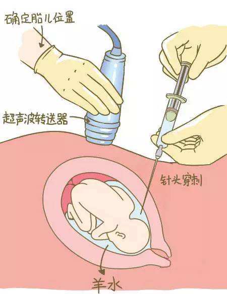 七种孕妇容易出唐氏儿,40岁孕妇唐氏筛查出高风险