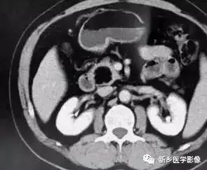 18种胰腺肿瘤，为什么我就知道两种