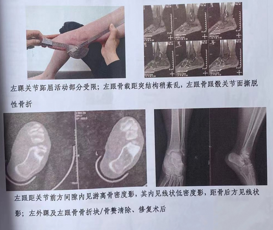 深蹲练习可以治疗膝关节吗,膝关节不好的人能练深蹲吗