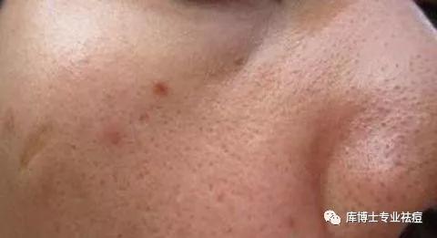 库博士祛痘手法,库博士祛痘痘效果怎么样