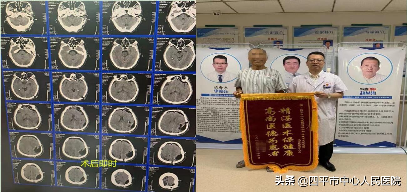 四平市中心医院介入血管外科,颅内胆脂瘤的克星