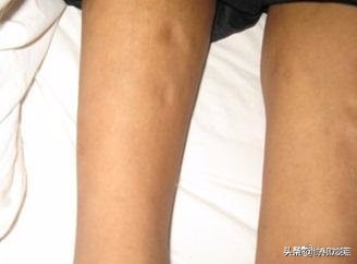 淋巴水肿治疗技术适应症,什么是淋巴水肿综合消肿治疗