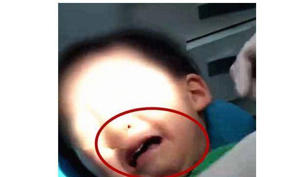 6岁男童被查出牙龈癌晚期,6岁孩子牙龈癌