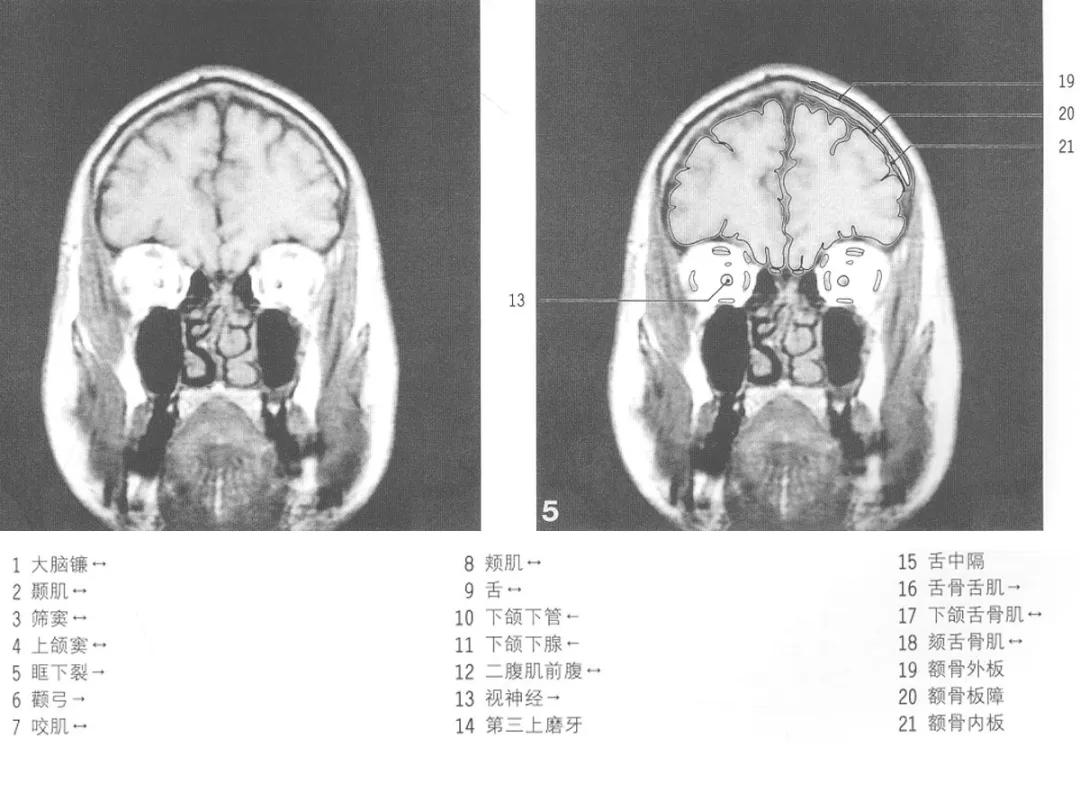 颅脑冠状状切面解剖图,颅脑mr解剖结构图