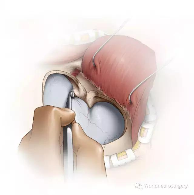 翼点入路的开颅要点,翼点开颅详解图
