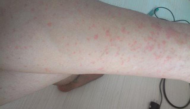 湿疹过来人的独家秘籍,湿疹患者的自救战