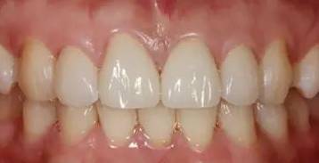 牙缝越来越大是什么导致的,牙缝越来越大什么病中医怎么说