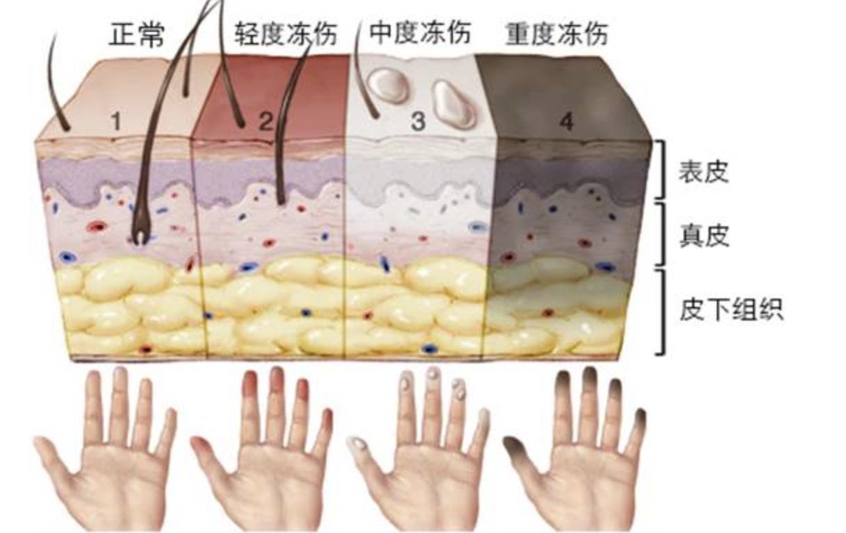 为什么被冻死的人脸上都挂着笑容,据说人被冻死的那一刻是温暖的