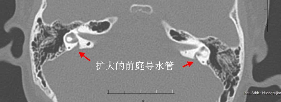 儿童突发性耳聋治愈率,孩子突发性耳聋治愈率有多少