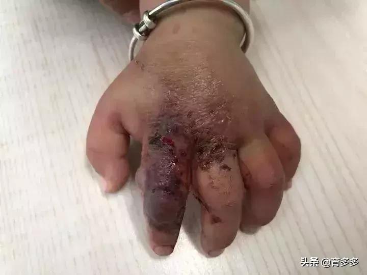 小孩手肿得像馒头,孩子手肿得像包子