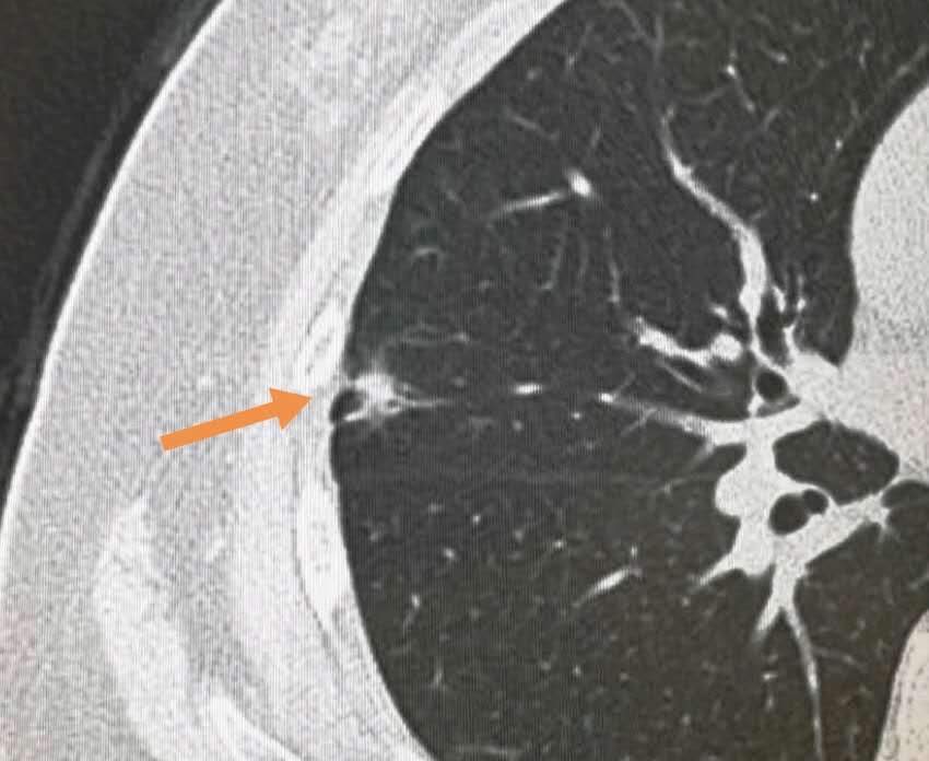 年年体检为啥查出癌症,每年正常体检能检查出肺癌吗