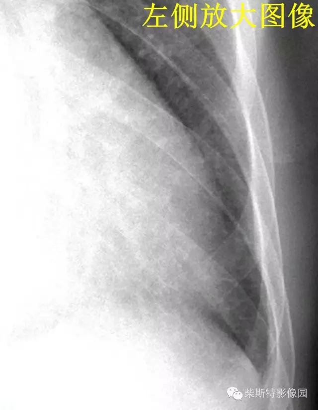 影像经典之KerleyA线、KerleyB线、KerleyC线