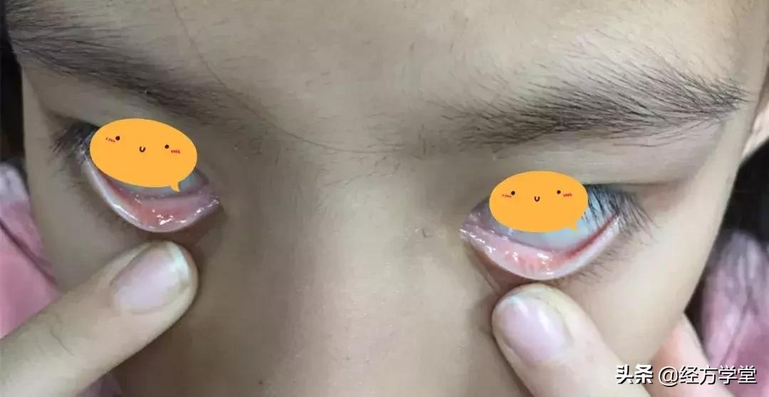 小儿感冒久治不好,小儿感冒反复发烧怎么办