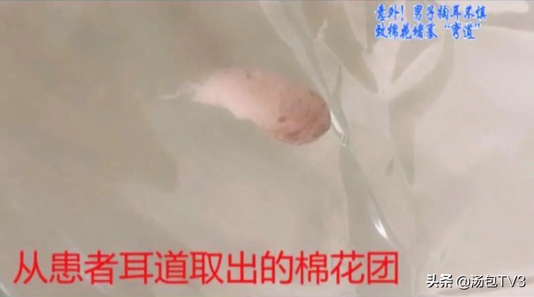 意外！男子掏耳不慎致棉花堵塞“弯道”