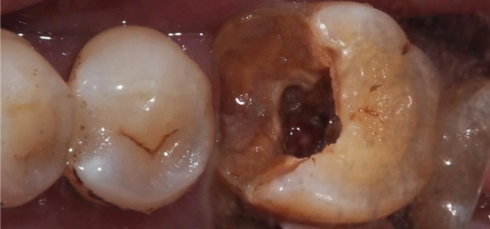 髓底穿孔为什么让拔牙,髓室底穿孔到底用不用拔牙