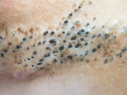 长痘痘的症状有哪些呢,长痘痘的原因及解决方法