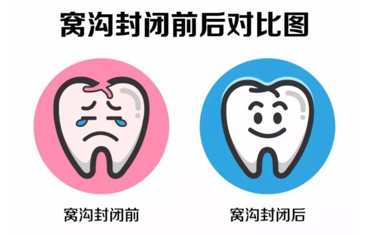 牙齿窝沟封闭多长时间可以刷牙,做完窝沟封闭当天可以刷牙吗