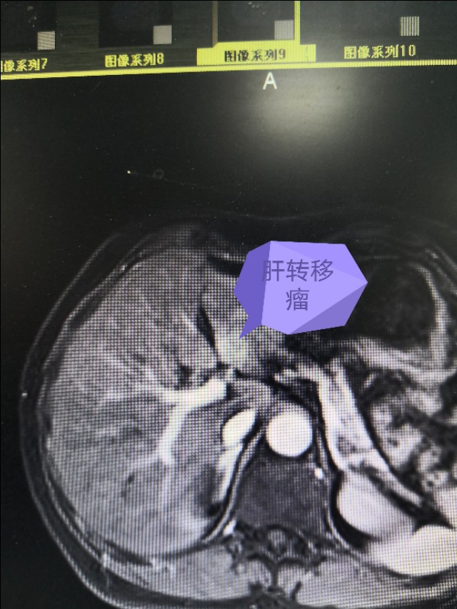 胆管癌癌症病人晚期,胆管癌晚期转移了要住院还是在家