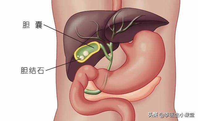 胆囊结石切除胆囊的后遗症有哪些,胆囊切除后我抑郁了害怕后遗症