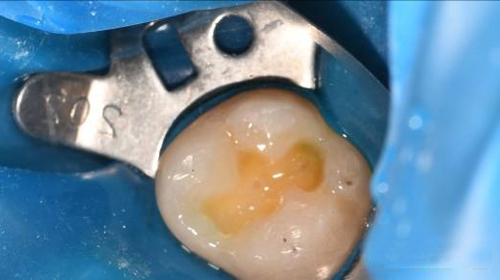 补牙有哪些流程,补牙以后需要注意什么