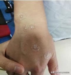 扎耳朵减肥效果好吗,耳针可以帮助减肥吗