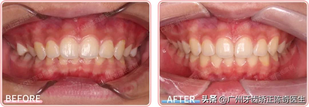 戴牙套会有下颌线,戴牙套的时候人会变丑吗