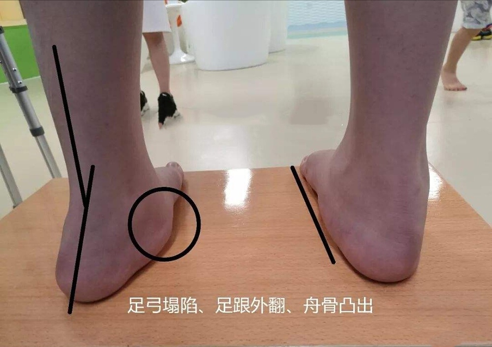 扁平足治疗手术费用,扁平足儿童专用鞋