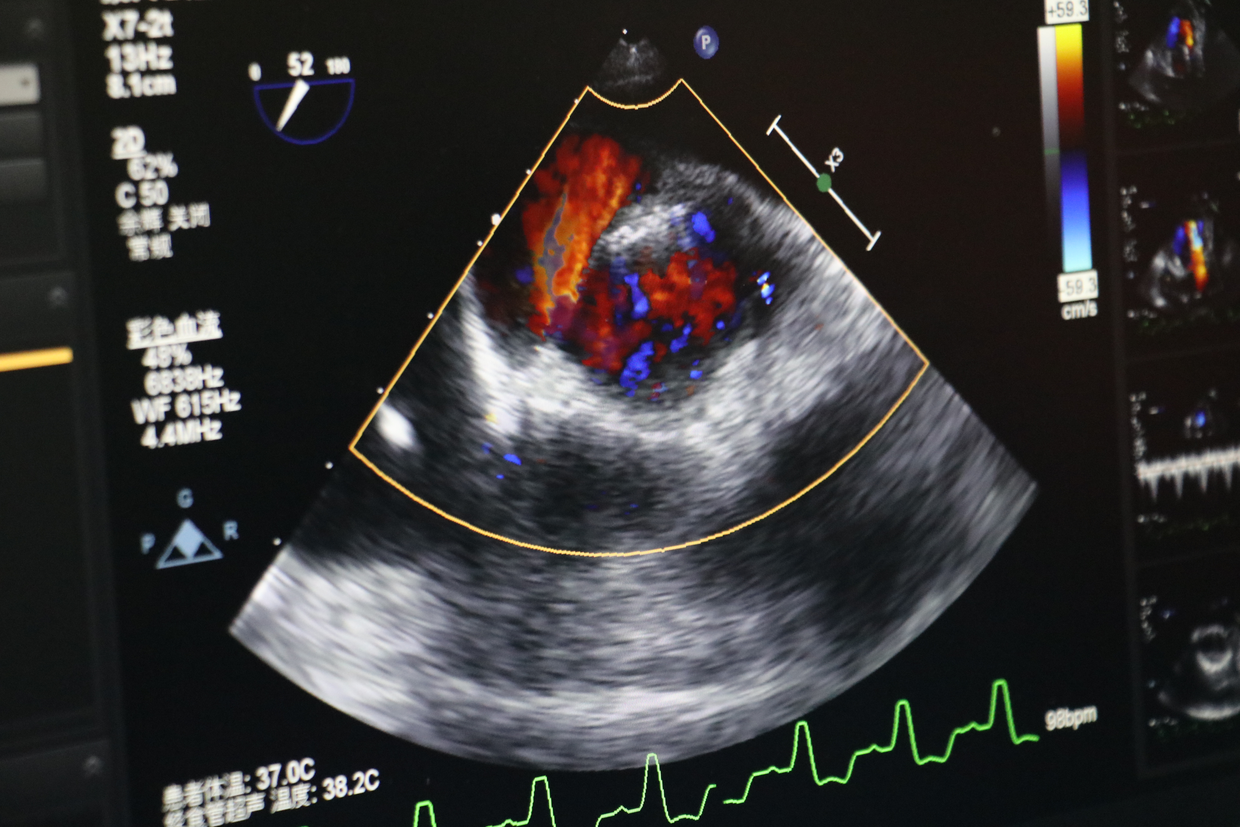 心脏病冠心病心血管疾病,冠心病心脏瓣膜病算是大病吗
