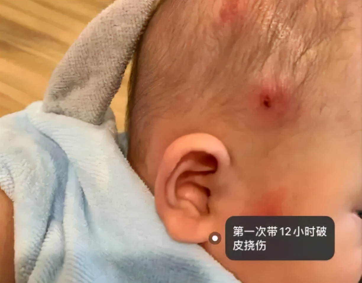 一岁宝宝睡偏头戴婴儿矫正头盔,七个月宝宝戴头盔多久能纠正头型