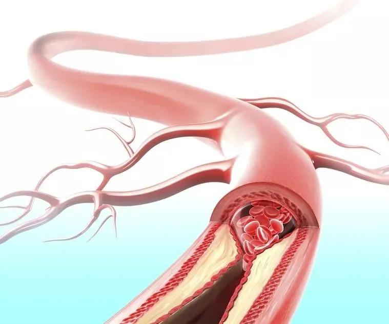 为什么股骨头坏死冬天疼痛厉害,为啥阴天股骨头疼